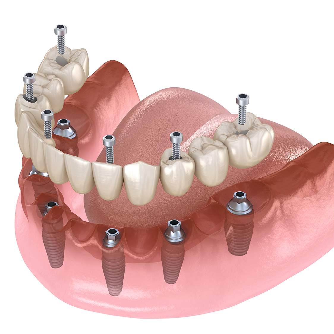 Prosthodontist Somerset West | Dental Implant Reconstruction