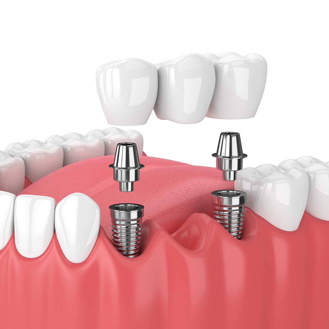 Somerset West Prosthodontist | Dental Implant Reconstruction