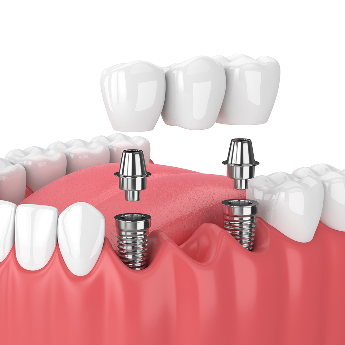 Prosthodontist Somerset West | Dental Implant Reconstruction Somerset West Prosthodontist | Dental Implant Reconstruction