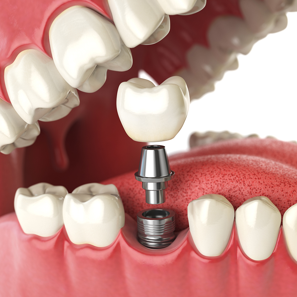Somerset West Prosthodontist | Dental Implant Reconstruction