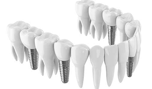 Dr Christian Vorster - Prosthodontist | Dental Implant Reconstruction