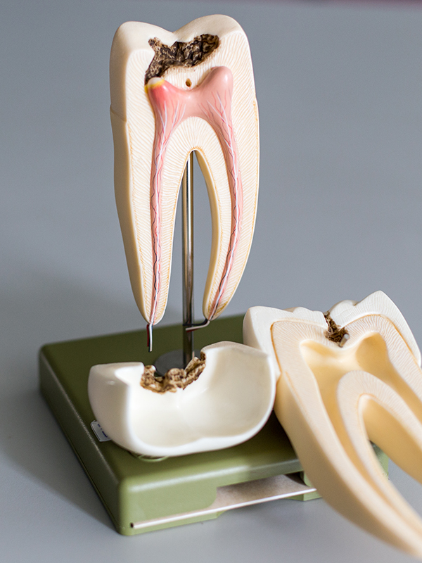 Prosthodontist Somerset West | Root Canal Root Canal | Dr Christiaan Voster