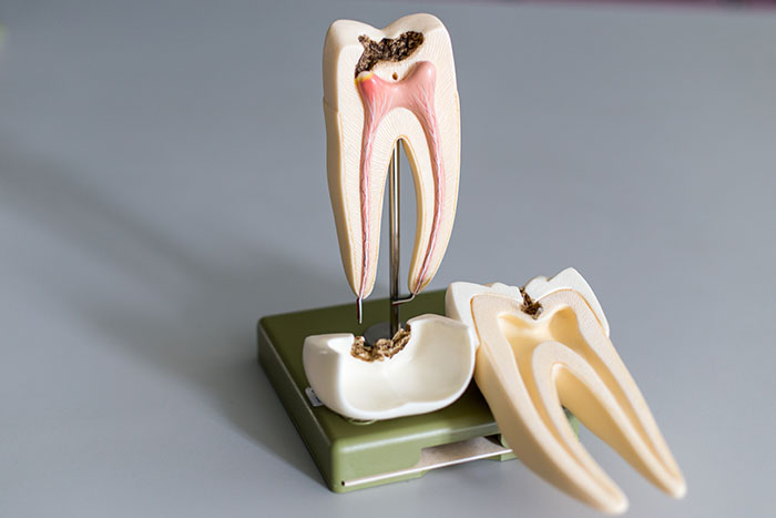 Root Canal | Dr Christiaan Voster
