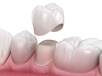 Prosthodontist Cape Town | Dental Restorations Dr Christian Vorster | Prosthodontist Cape Town