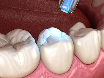 Prosthodontist Cape Town | Dental Restorations