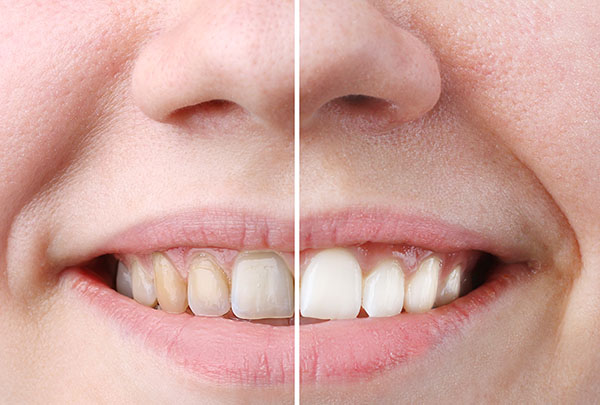 Strand Prosthodontist | Teeth Whitening