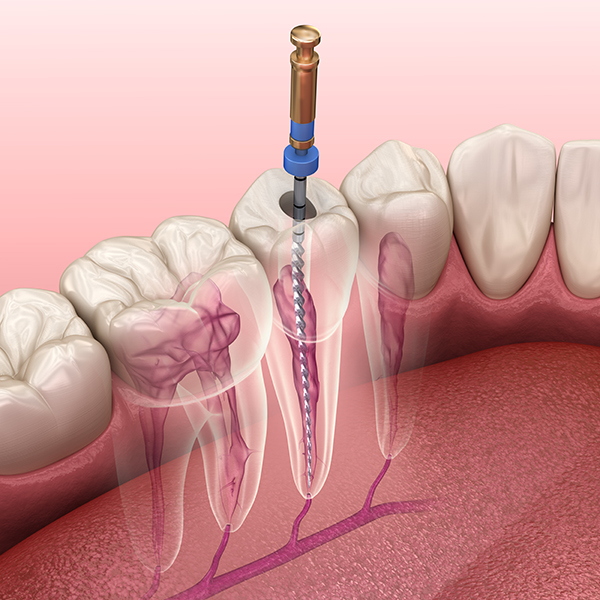 Root Canal | Dr Christiaan Voster