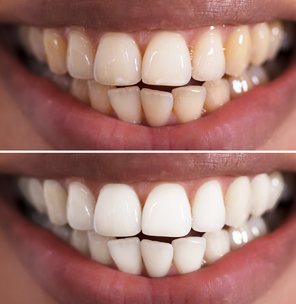 Whitening teeth Teeth Whitening